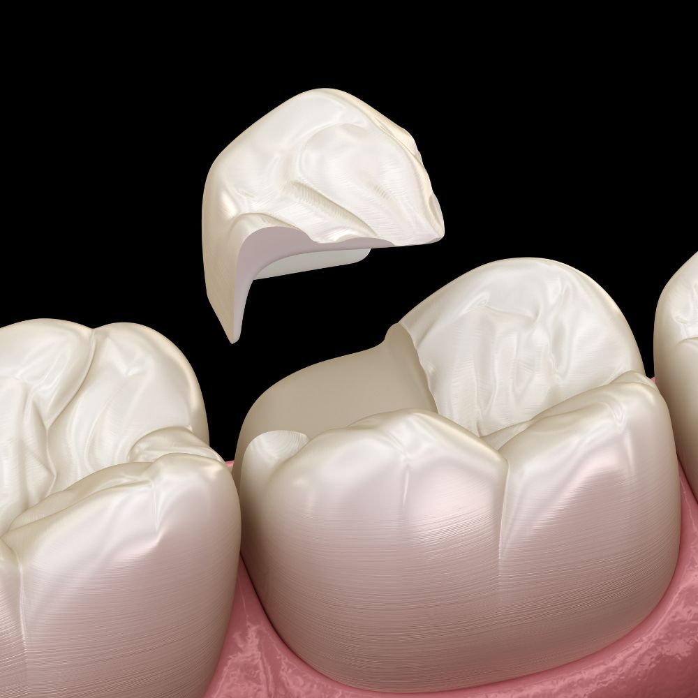 Broken Tooth Repair in Brandon