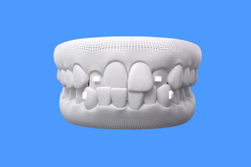 What are Invisalign Attachments