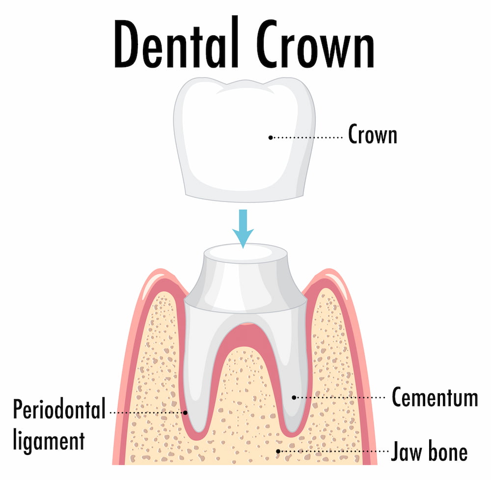 Why Dentists Recommend Dental Crowns