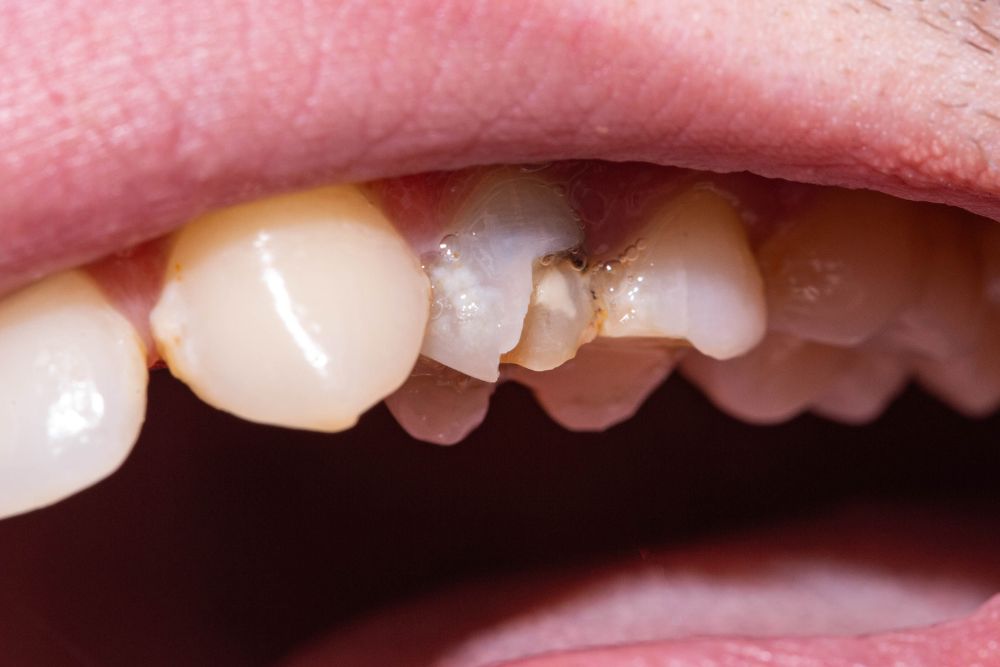 How Dentists Repair Chipped vs Broken Teeth in Brandon